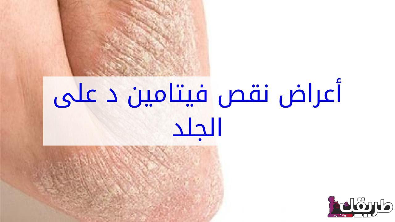 ما هى أعراض نقص فيتامين د عند الفتيات 4 680958499683806